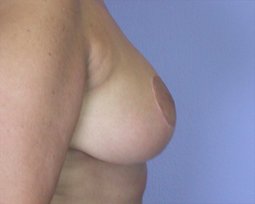 Breast Reduction (for Women) before and after photo