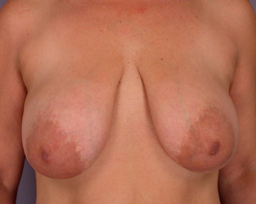 Breast Reduction (for Women) before and after photo