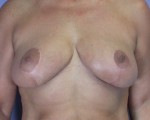 Breast Reduction (for Women)