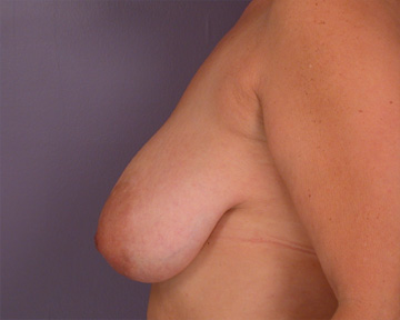 Breast Reduction (for Women) before and after photo