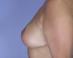 Breast Reduction (for Women)