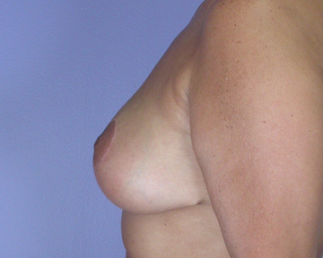 Breast Reduction (for Women) before and after photo