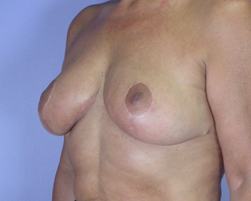 Breast Reduction (for Women) before and after photo