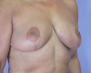 Breast Reduction (for Women) before and after photo