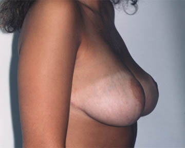 Breast Reduction (for Women) before and after photo