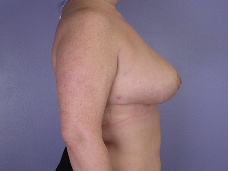 Breast Reduction (for Women) before and after photo