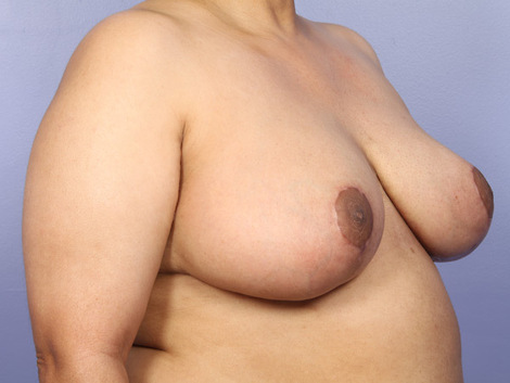 Breast Reduction (for Women) before and after photo