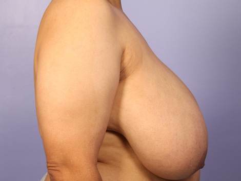 Breast Reduction (for Women) before and after photo