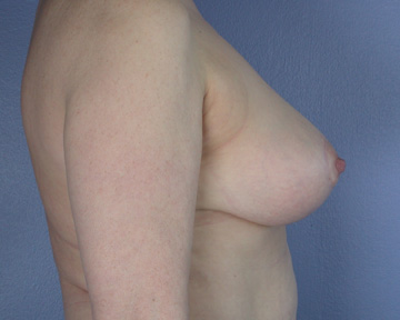 Breast Reduction (for Women) before and after photo