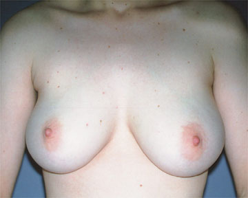 Breast Reduction (for Women) before and after photo