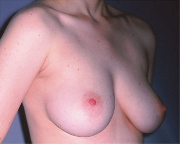 Breast Reduction (for Women) before and after photo