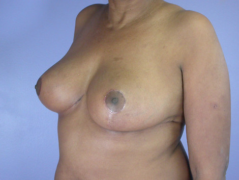 Breast Reduction (for Women) before and after photo