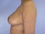 Breast Reduction (for Women) Before and after photo