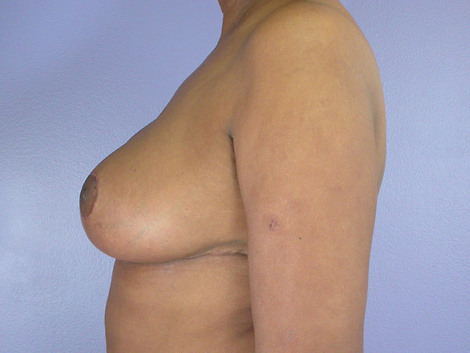 Breast Reduction (for Women) before and after photo