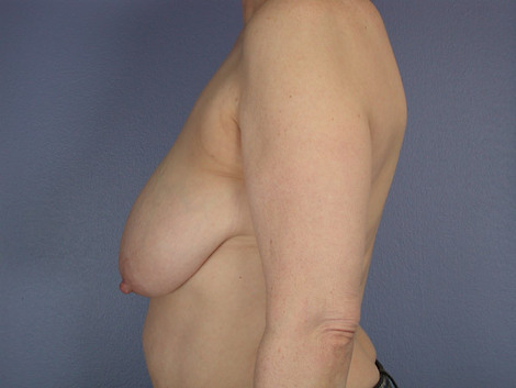 Breast Reduction (for Women) before and after photo