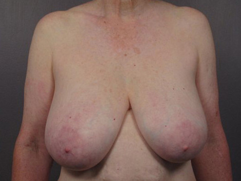 Breast Reduction (for Women) before and after photo