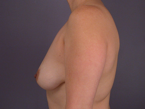 Breast Lift with Augmentation before and after photo