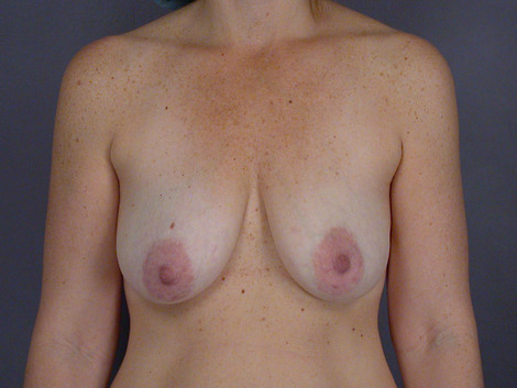 Breast Lift with Augmentation before and after photo