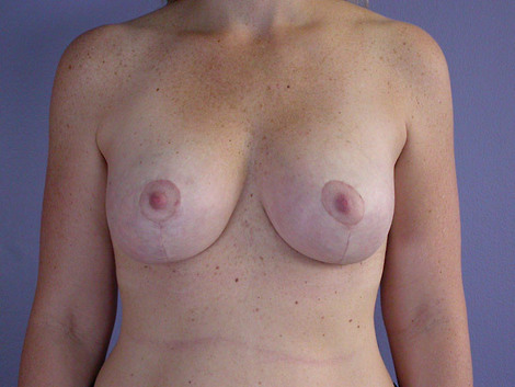 Breast Lift with Augmentation before and after photo