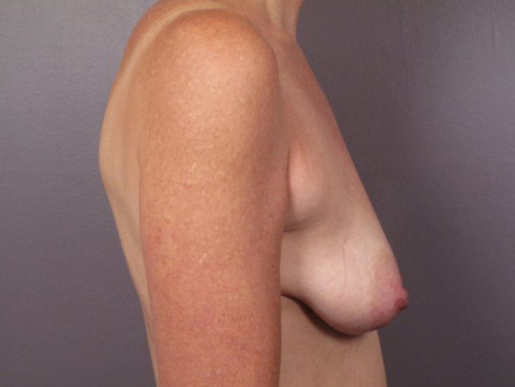 Breast Lift with Augmentation before and after photo