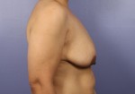 Breast Lift with Augmentation Before and after photo