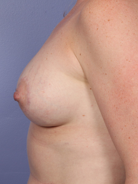 Breast Lift with Augmentation before and after photo