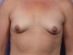 Breast Lift with Augmentation