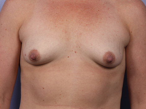 Breast Lift with Augmentation before and after photo