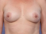 Breast Lift with Augmentation