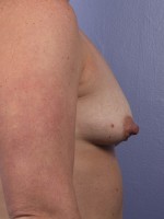 Breast Lift with Augmentation Before and after photo