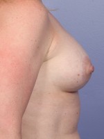 Breast Lift with Augmentation Before and after photo