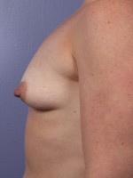 Breast Lift with Augmentation Before and after photo