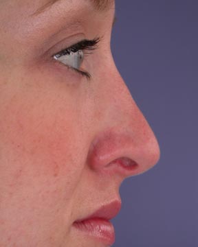 Nose Reshaping before and after photo