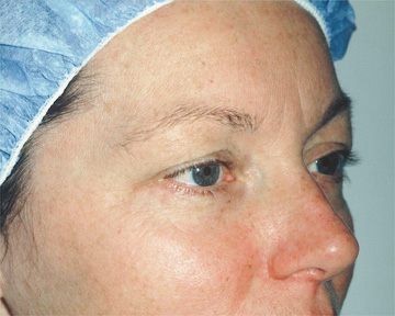 Eyelid Surgery before and after photo