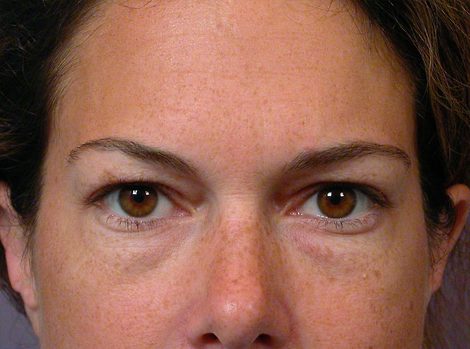 Eyelid Surgery before and after photo