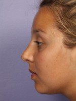 Nose Reshaping Before and after photo