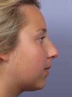 Nose Reshaping Before and after photo