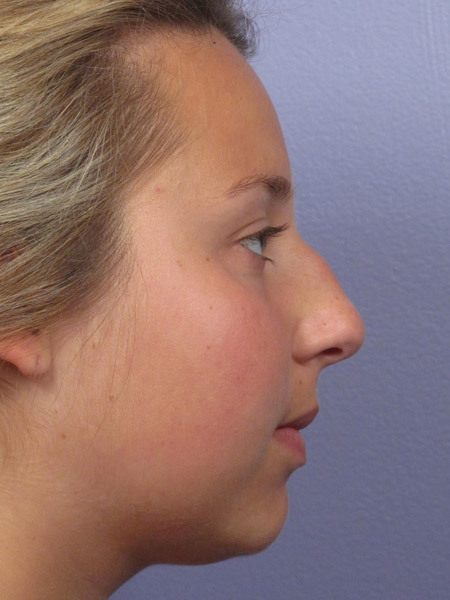 Nose Reshaping before and after photo