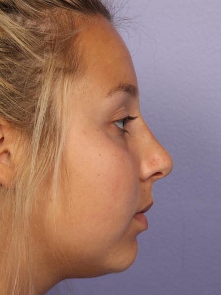 Nose Reshaping before and after photo