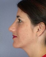 Nose Reshaping Before and after photo