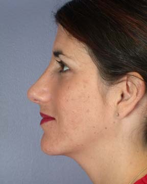 Nose Reshaping before and after photo