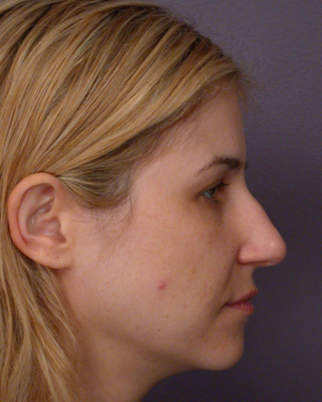 Nose Reshaping before and after photo