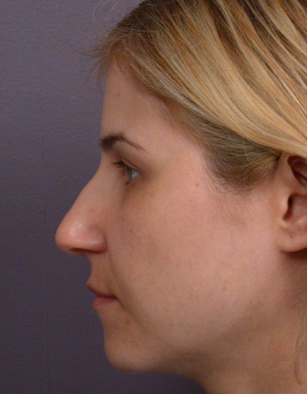 Nose Reshaping before and after photo