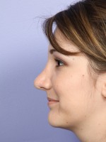 Nose Reshaping Before and after photo