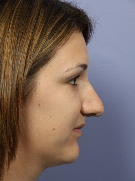 Nose Reshaping before and after photo