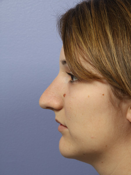 Nose Reshaping before and after photo