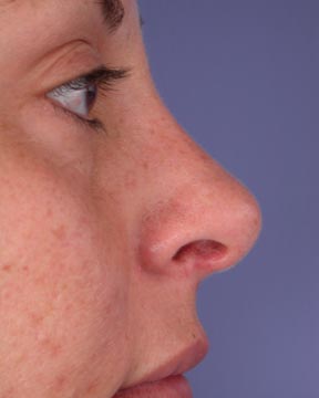 Nose Reshaping before and after photo