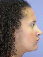 Nose Reshaping Before and after photo