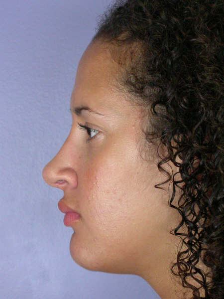 Nose Reshaping before and after photo