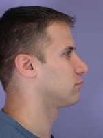 Nose Reshaping Before and after photo